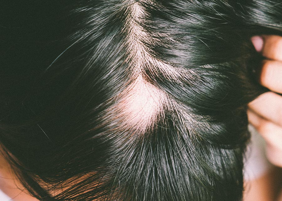 Alopecia areata - Clínica IDEAL - Dermatologia Capilar