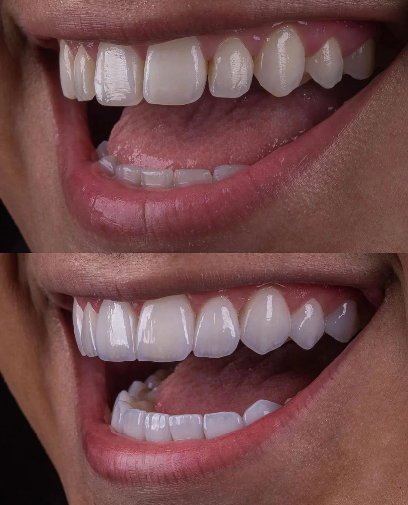 Facetas Odontológicas Removíveis