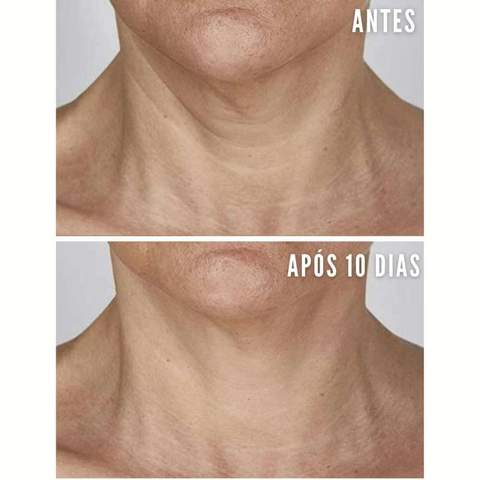 beauty_face_adesivos_de_silicone_rejuvenescimento_facial