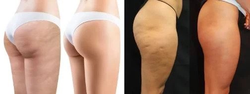 redutor-antes-depois