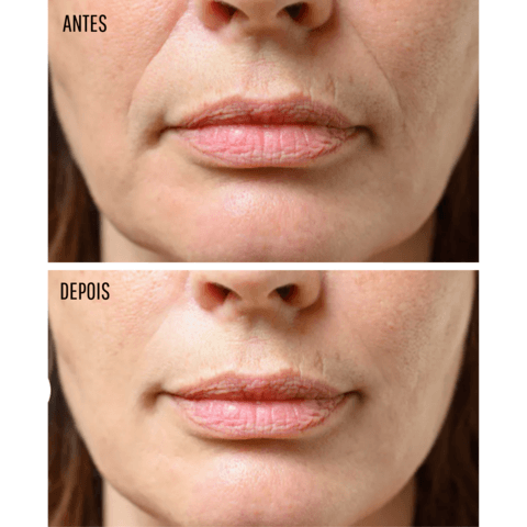 beauty_face_adesivos_de_silicone_rejuvenescimento_facial