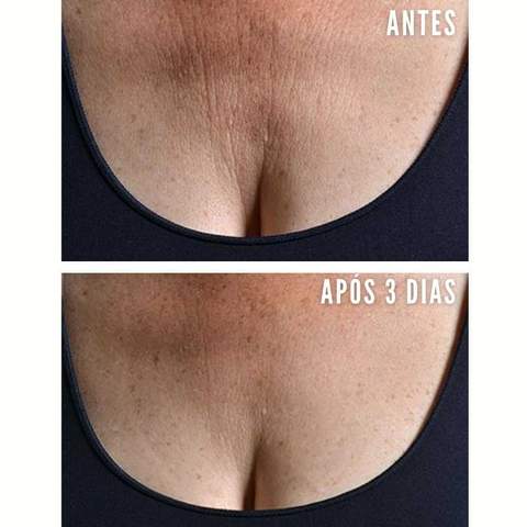 beauty_face_adesivos_de_silicone_rejuvenescimento_facial