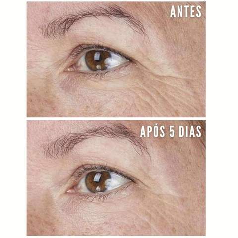 beauty_face_adesivos_de_silicone_rejuvenescimento_facial