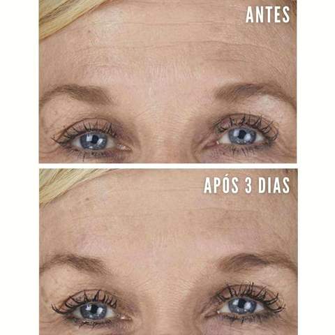 beauty_face_adesivos_de_silicone_rejuvenescimento_facial