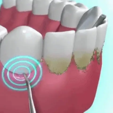 Irrigador Oral para Limpeza Bucal - CleanJet